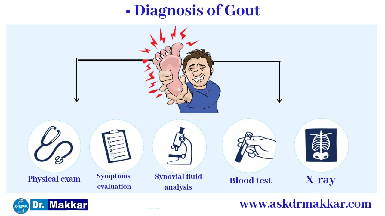 Gout Homeopathic Treatmnet,Gout Related To Hyperuricemia Means High ...